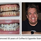 Rock Star Teeth Whitening