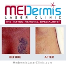 MEDermis Laser Clinic - Tattoo Removal