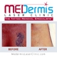 MEDermis Tattoo Removal