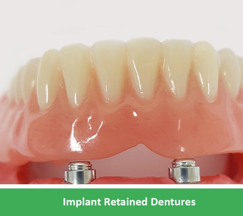 Complete Denture Care - Wantirna, VIC. Implant Retained Dentures