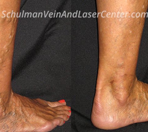 Martin Schulman, MD - Schulman Vein and Laser Center - Commack, NY