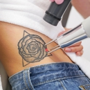 LaserAway - Tattoo Removal