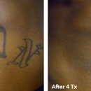 Eraser Clinic Laser Tattoo Removal - Tattoo Removal