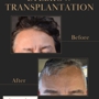 Arocha Hair Restoration