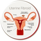 USA Fibroid Centers