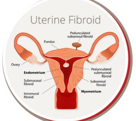 USA Fibroid Centers - Washington, DC