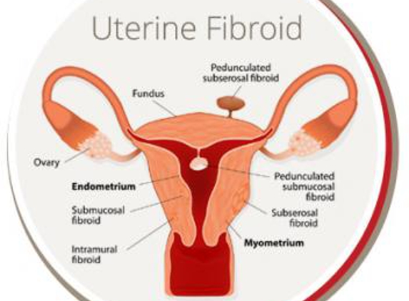 USA Fibroid Centers - Morgantown, WV