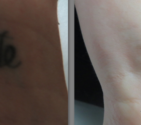 Clear Out Ink Laser Tattoo Removal LLC - Henderson, NV