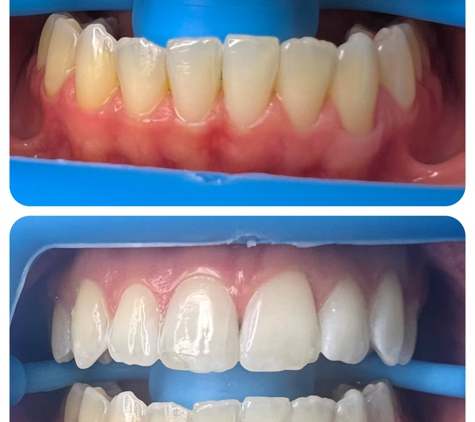 Flawless Whitening Studio by Candace - Merced, CA. Before and after 1 hour session