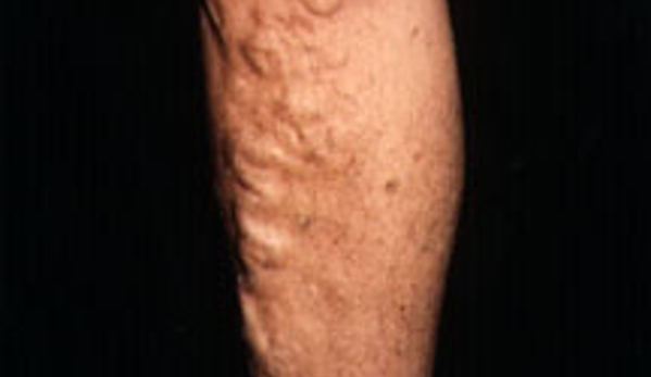 Martin Schulman, MD - Schulman Vein and Laser Center - Commack, NY