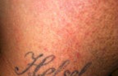 Houston Tattoo Removal Clinic - Houston, TX 77034