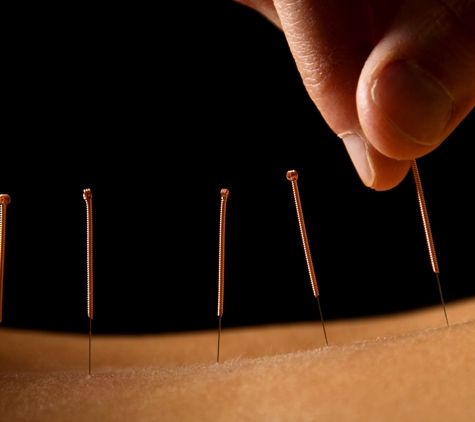 6S PHYSIO - Tumbi Umbi, NSW. Acupuncture delivered by experienced TCM practitioners; Dry needling performed by Physios