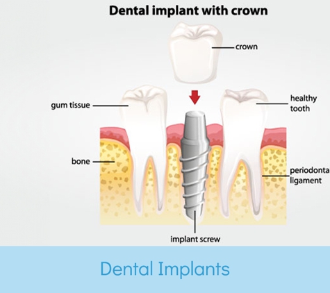 Dentalspa;.Com Pty Ltd - Geelong, VIC. Dental Implants