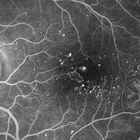 Island Retina - Vitreoretinal Consultants of NY