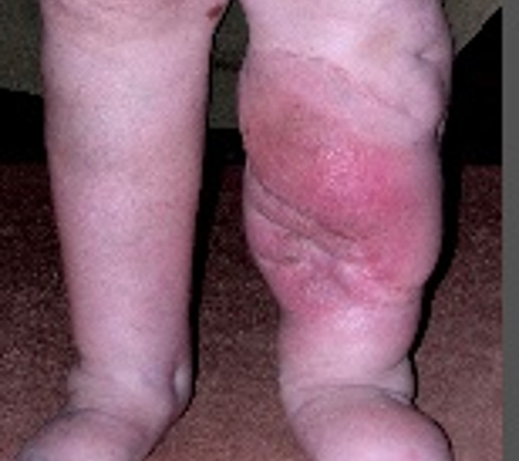 Lymphoedema Clinic Adelaide - Walkerville, SA