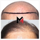 MAXIM Hair Restoration