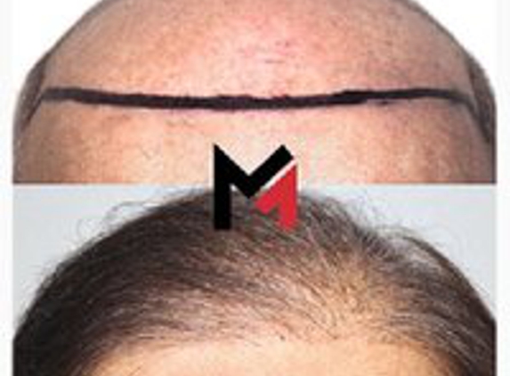 MAXIM Hair Restoration - Sarasota, FL