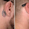 ReversaTatt Tattoo Removal gallery