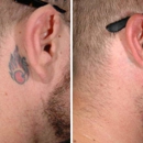 ReversaTatt Tattoo Removal - Tattoo Removal