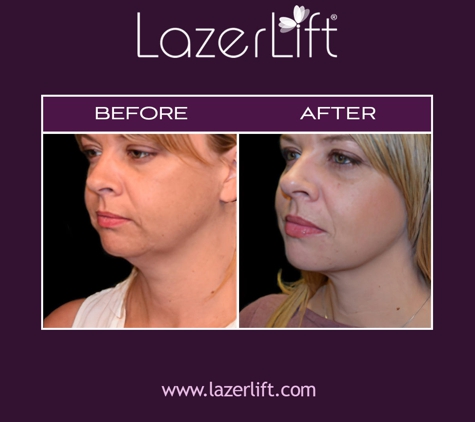 LazerLift Tampa - Tampa, FL