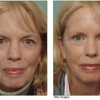 Allcroft Facial Plastic Surgery gallery