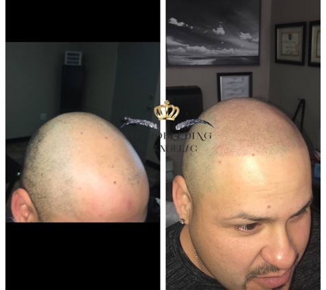 Microblading By Angelac - Visalia, CA. Scalp Micropigmentation is a cosmetic tattooing technique used to cover balding or thinning areas of the scalp, giving hair like follicles, adding the illusion of density to thinning hair, camouflage scars and patches of alopecia. 

Price depends on how much coverage is needed, call to get an estimate or set up a consultation.
#microbladingbyangelac #smp #scalpmicropigmentation  #hairlosssolution 
#scalpmicropigmentationvisalia