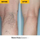 Metro Vein Centers | Florham Park