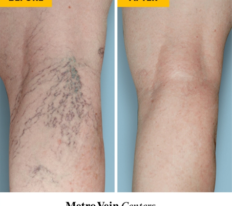 Metro Vein Centers | Florham Park - Florham Park, NJ