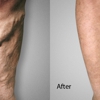 Advanced Varicose Vein Treatments of Manhattan gallery