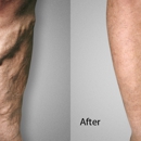 Advanced Varicose Vein Treatments of Manhattan - Physicians & Surgeons, Dermatology