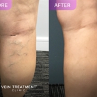 Vein Treatment Clinic | East Dallas