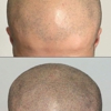 Semper Hair Scalp Micropigmentation gallery