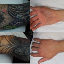 Oregon Aesthetics - Tattoo Removal