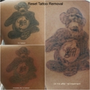 Reset Tattoo Removal - Tattoo Removal