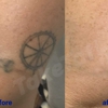 TakeTatt Tattoo Removal gallery