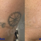 TakeTatt Tattoo Removal