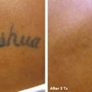 Eraser Clinic Laser Tattoo Removal - Tattoo Removal