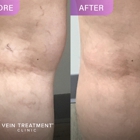 Vein Treatment Clinic | Fort Worth