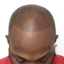 Impressions Scalp Micropigmentation - Hair Replacement