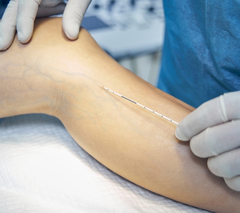 Charming Skin Vein Clinics - Chicago, IL. Endovenous Laser Treatment EVLT