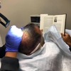 NeoGraft Hair Restoration Orange County gallery