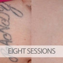 Eraditatt Tattoo Removal of Tampa - Tattoo Removal