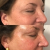 Collagen Bar NYC Microneedling and Body Contouring gallery