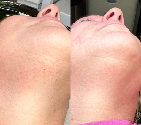 Crystal Skin Care - Kaysville, UT. Laser Hair Removal: Before and After