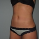 St. Louis Laser Liposuction Center