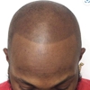 Impressions Scalp Micropigmentation gallery