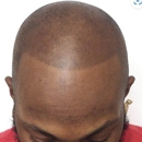 Impressionsbuffalo - Hair Replacement