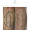 Erase & Embrace Tattoo Removal gallery