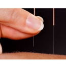 The Neighborhood Acupuncture Project - Acupuncture