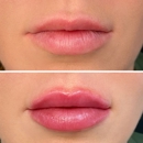 LivingYoung Center for Health & Anti-Aging - Odessa - Hair Removal